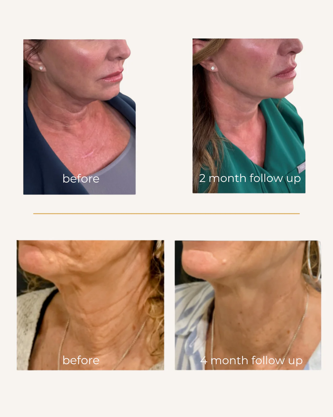 A jawline and neck from the side, before Sofwave and two months after