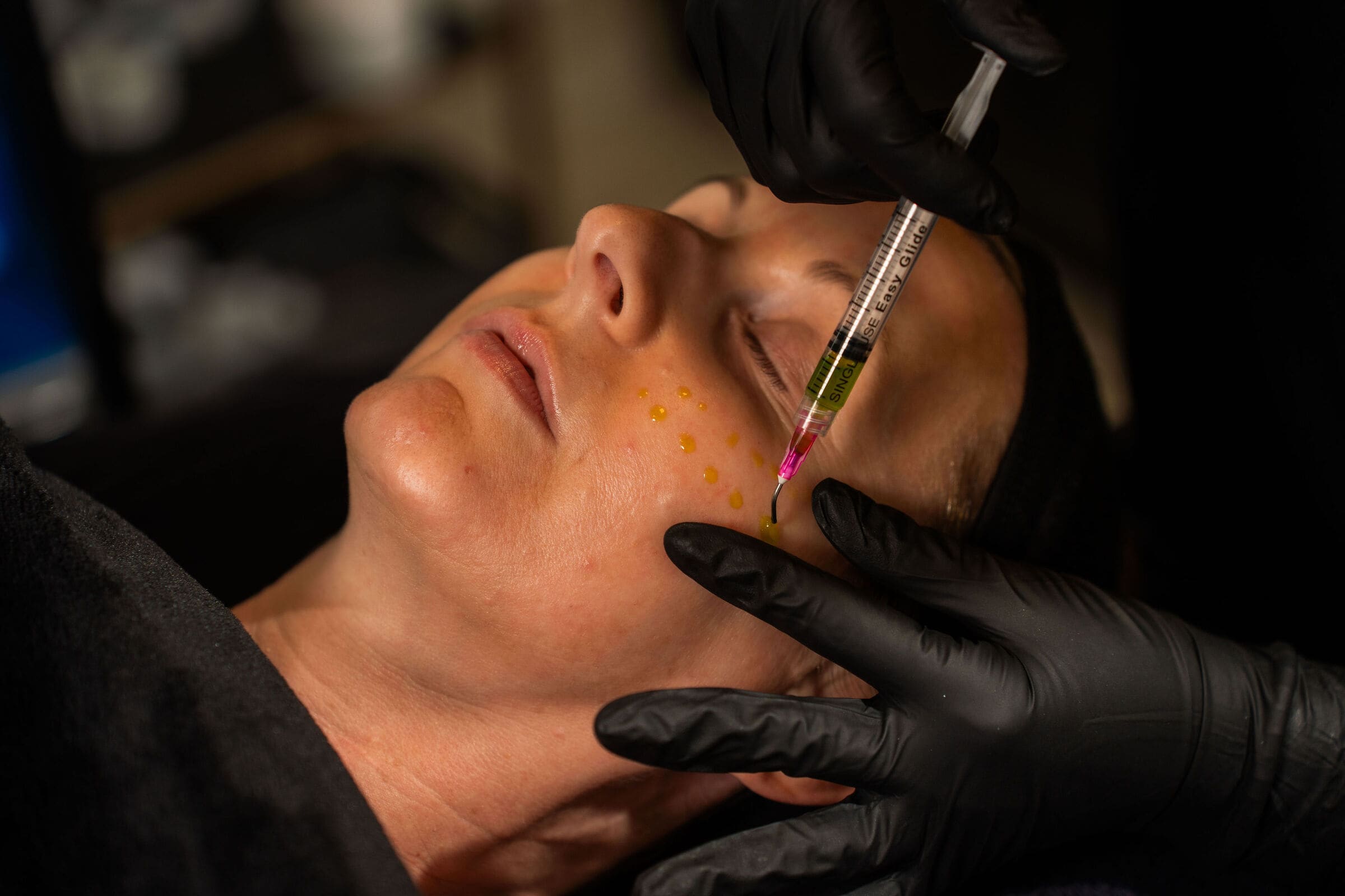 Chemical Peels